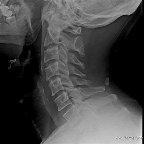 Sesamoid ossicle of nuchal ligament | Radiology Case ...