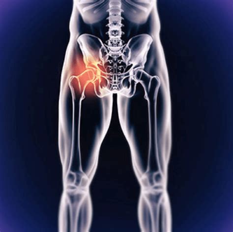 Joint Replacement Worcester County Orthopedics