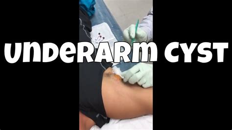 Underarm Cyst Original File 1080p Youtube