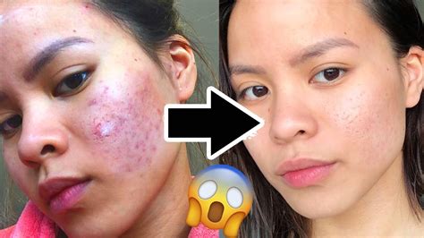 How To Heal A Cut On Face Without Scarring