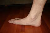 Images of Pain From Flat Feet