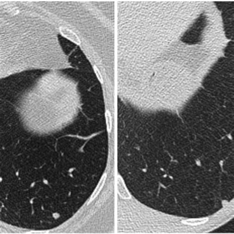 Axial Ct Images Of Two Small Left Lower Lobe Solid Nodules These