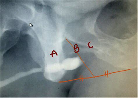 Pd29 09 Prediction Of Intraoperative Difficulty And Outcome Of