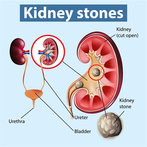 Kidney Stones Symptoms Diagnosis Treatment And More Legit Trend