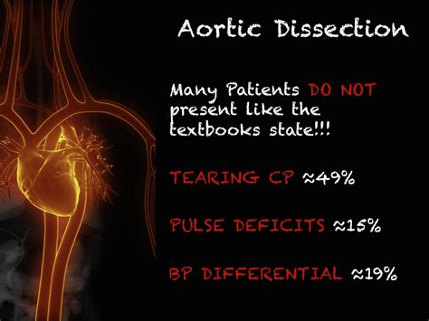 Salim R Rezaie Md On Twitter Nice Overview Of Aortic Dissection Via