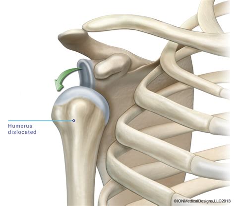 Shoulder Dislocation Joint Preservation Center