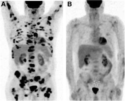 In Newly Diagnosed Diffuse Large B Cell Lymphoma Determination Of Bone