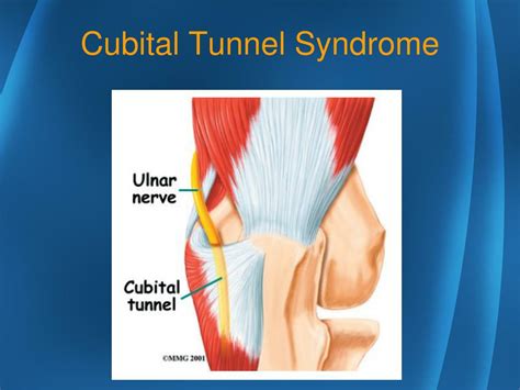 Ppt Musculoskeletal Disorders Cubital Tunnel Syndrome Powerpoint