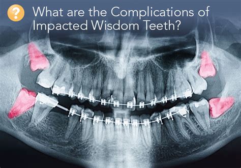 A Guide To The Complications Of The Removal Of Impacted Wisdom Teeth