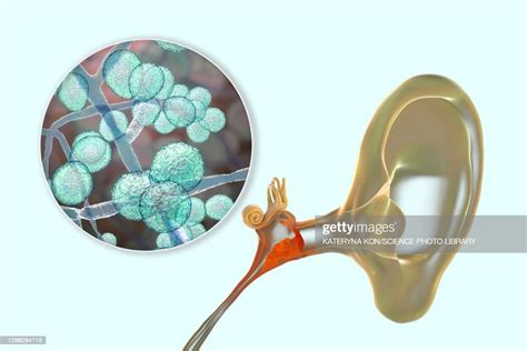 Chronic Fungal Otitis Media Ear Infection Illustration Illustration