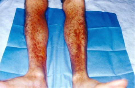 Purpuric Rash On The Patients Legs With Areas Of Hyperpigmentation
