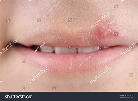 Close Up Of Lips Affected By Herpes Stock Photo 53580727 Shutterstock