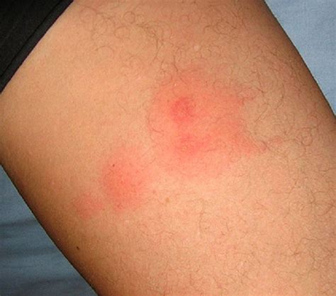 What Do Bed Bug Bites Look Like What Do Bed Bug Bites Look Like Bed