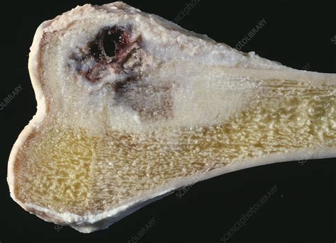 Bone Cancer Stock Image M1310430 Science Photo Library