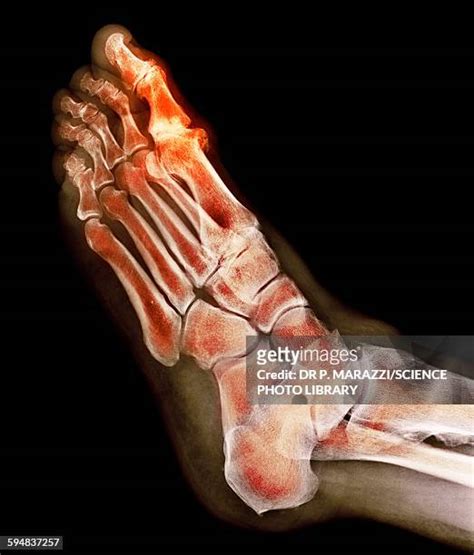 Toe Deformity Photos And Premium High Res Pictures Getty Images