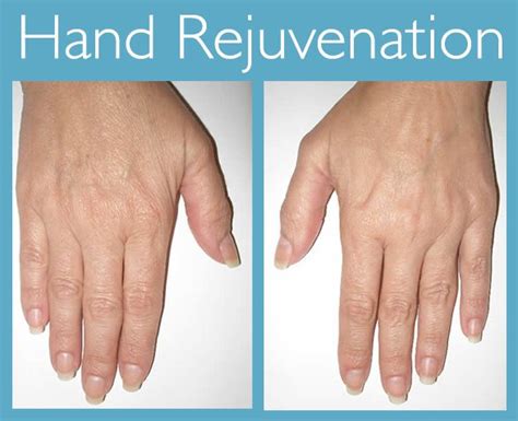 Aging Hands Dermal Fillers For Hand Rejuvenation Dermatology And