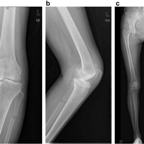 Radiographs Of Left Knee After Proximal Fibula Osteotomy A