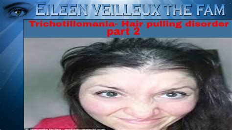 Trichotillomania Hair Pulling Disorder Part 2 Eileen Veilleux The Fam Youtube