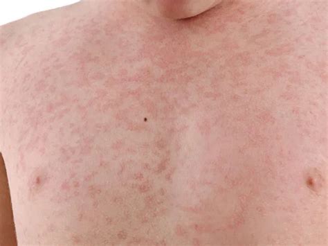 Measles Definition Of Measles