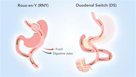 What To Expect Of A Revision From Rny To Ds Rny Gastric Bypass Revision Surgery Gastric Bypass