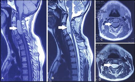 Magnetic Resonance Imaging Of Spine Showing Neurenteric Cyst White