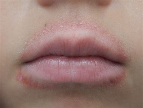 Why Does The Area Around My Lips Itchy