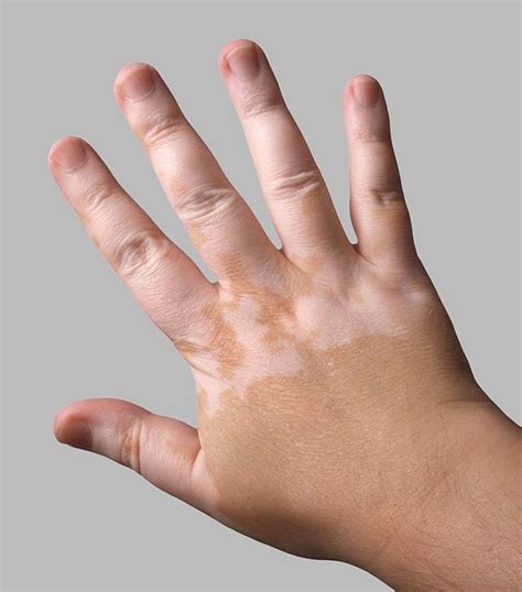 Vitiligo Symptoms Treatments And Causes Healthdirect