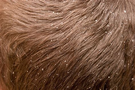 Got Dandruff The Bacteria Living On Your Head Might Be To Blame New