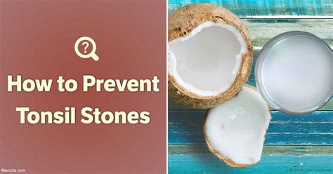 How To Prevent Tonsil Stones