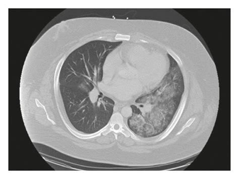 Computed Tomographic Angiogram Of The Chest Showing Bilateral