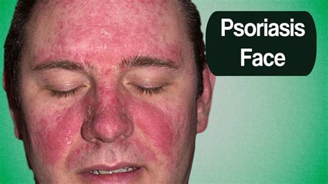Psoriasis Face Home Remedies For Scalp Psoriasis Natural Remedies For