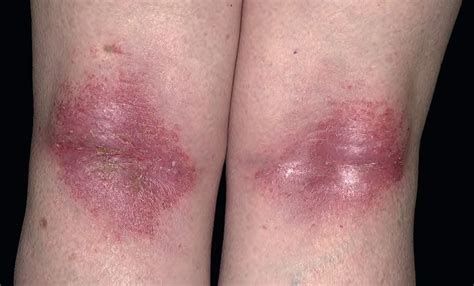 Eczema Dermatita Atopica Simptome Cauze Tratament Hot Sex Picture