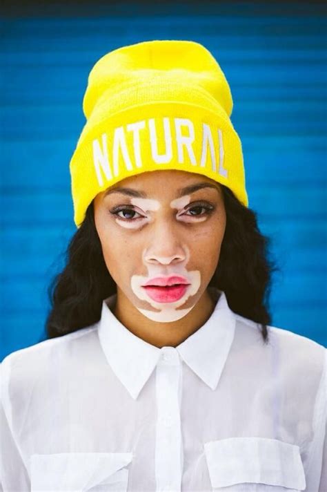 Woman With Vitiligo Models How Beautiful Looking Different Can Be