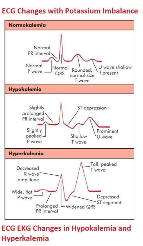 Hypokalemiaelectrolyte Imbalance