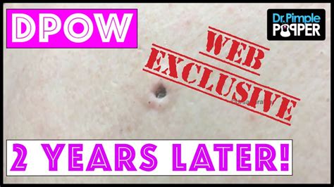 Web Exclusive Sneak Peek Dilated Pore Of Winer On Back Revisited Two