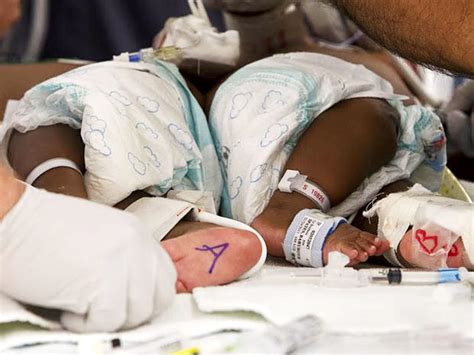 Medical Miracle Conjoined Twins Separated In Memphis Photo 3 Cbs News