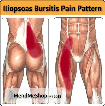 All About Iliopsoas Bursitis