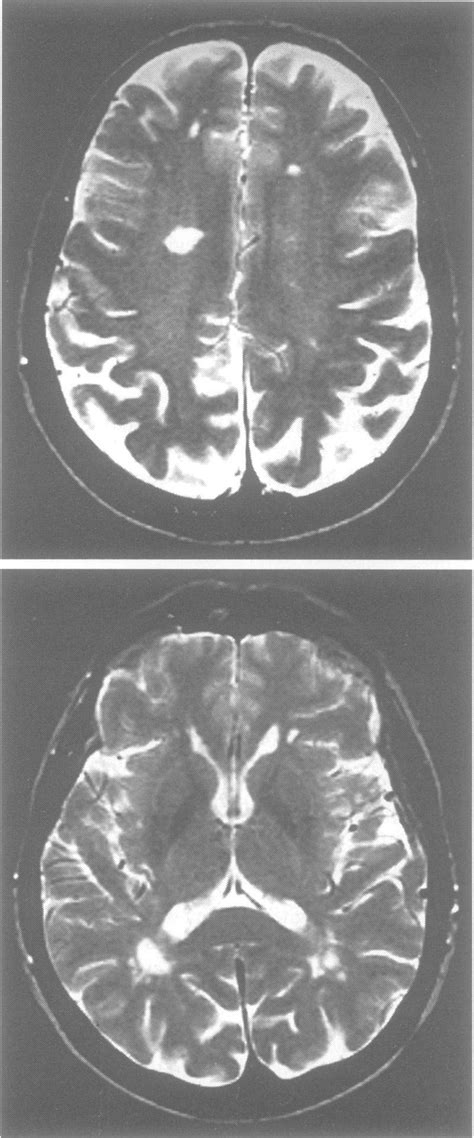 T2 Weighted Brain Mri Showing White Matter Changes And Small Putaminal
