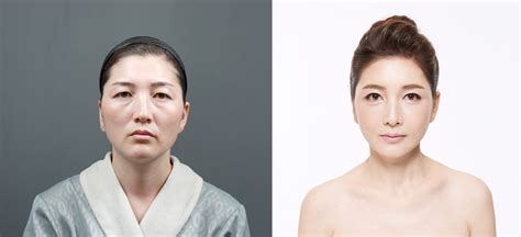 The Most Popular Plastic Surgery Operation In South Korea Has A