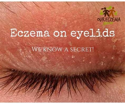 Eczema On Eyelids What Are The Causes And How Can You Treat It Eczema