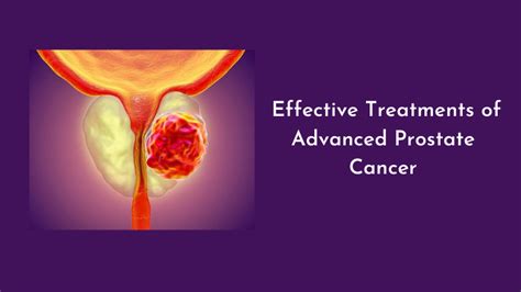 Category Prostate Cancer Treatment Disease And Medications