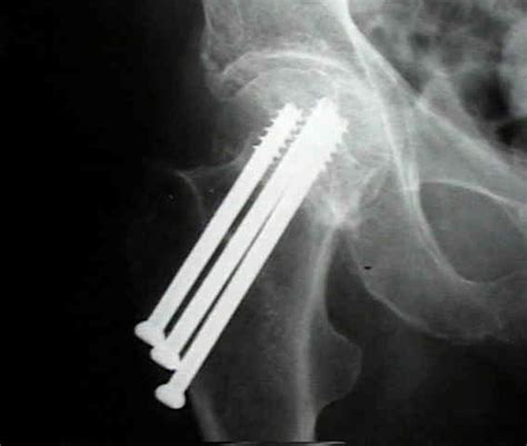 Cannulated Screws For Femoral Neck Fracture Wheeless Textbook Of