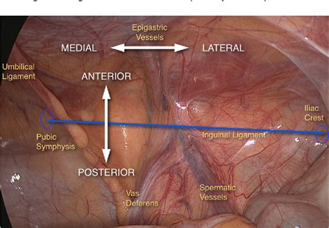 Pdf Systemization Of Laparoscopic Inguinal Hernia Repair Tapp Based On A New Anatomical