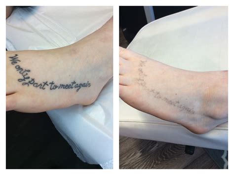 how many sessions to remove tattoo laser sugar land laser tattoo removal prices in houston tx