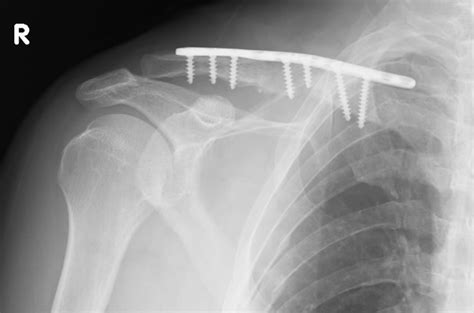 Late Thoracic Outlet Syndrome After Clavicle Fractures In Patients With