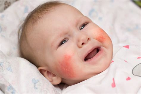 Signs To Know That Your Baby Has Allergies The Pulse