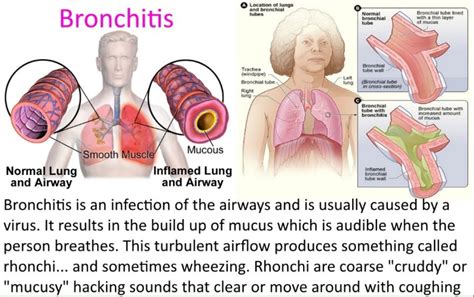 Bacterial Pneumonia Archives Putnam Ridge