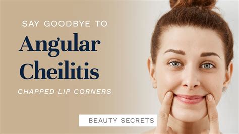 How To Get Rid Of Angular Cheilitis Chapped Lip Corners Youtube
