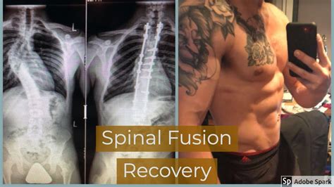 I Ve Had A Spinal Fusion Done It S Actually One Of The Largest Spinal