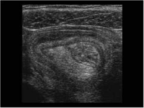 Pediatrics 91 Pediatric Abdomen And Retroperitoneum Case 912